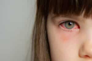 conjunctivitis or pink eye in young girl's right eye, very irritated