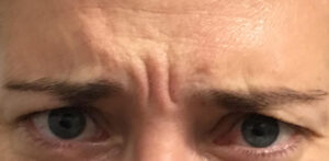 Botox (Forehead)
