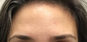 Botox (Forehead)