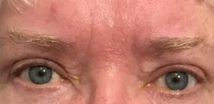Cosmetic Lower Eyelid