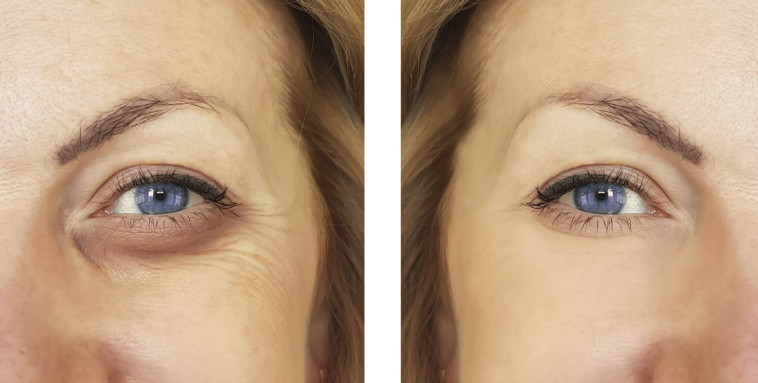 woman, eye swollen before and after procedures, treatm