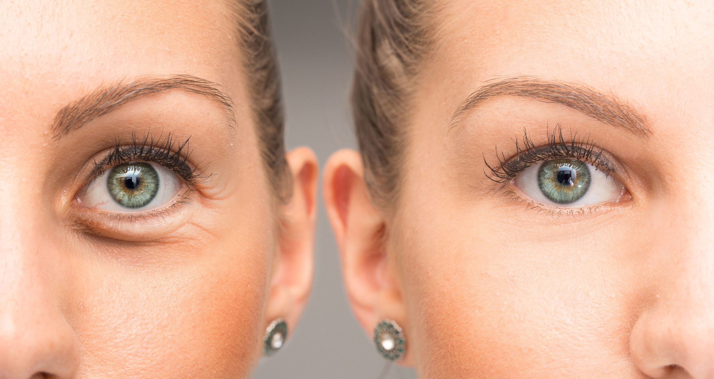 Female eye with wrinkles and crow's feet before and after cosmetic treatment
